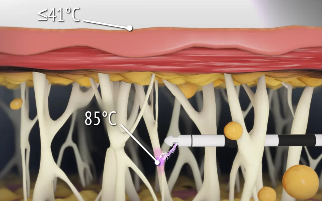 Figure 3 – Illustration mettant en évidence l’échauffement du réseau fibro-septal jusqu’au point de contraction instantanée (85°C), tout en maintenant des températures cutanées sécuritaires (≤41°C)